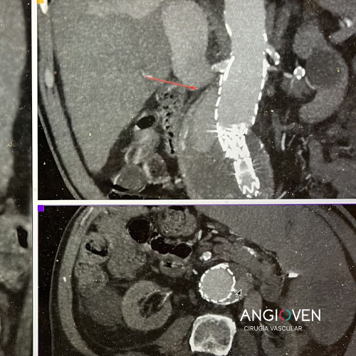 Avances en la Cirugía Endovascular de Aorta